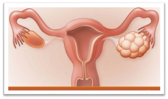 PCOS & PCOD